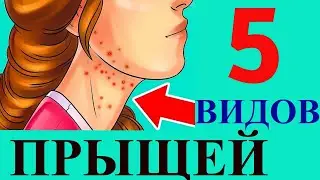 Как избавиться от прыщей на лице в домашних условиях? 5 видов акне | Я знаю