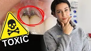 Are Dental Implants TOXIC!? Don't Get Them Before Hearing This!