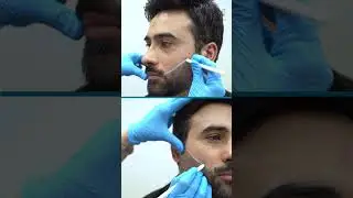 Laser Beard Shaping for Sharp Looks | The Aesthetics Clinic #beardgrooming  #menstyle