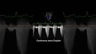 Understanding Dynamic and Fixed Obstruction in TOF #shorts #echocardiography #ultrasound #pediatrics