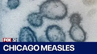 Chicago measles outbreak: Who is at risk? How fast does it spread?