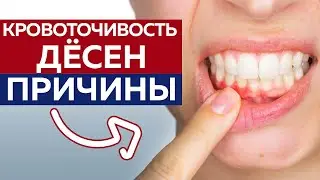 Почему при чистке зубов идет кровь? / Лечение десен. Чем опасна кровоточивость?!