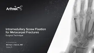 Intramedullary Screw Fixation for Metacarpal Fractures