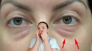 Effective massage for UNDER EYE BAGS and PUFFY EYES