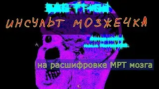 Ишемический ИНСУЛЬТ МОЗЖЕЧКА на МРТ расшифровке головного мозга