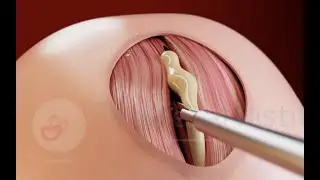 Percutaneous mini-laparotomy fetoscopic treatment of Open Spina Bifida