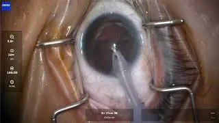 Fastest 3 min Cataract Surgery (unedited) - Dr Chan Jan Bond