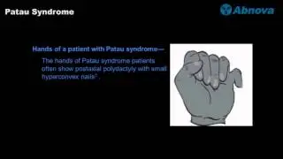 Patau Syndrome