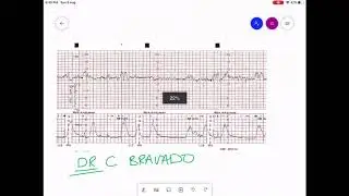 CARDIOTOCOGRAPHY | CTG INTERPRETATION