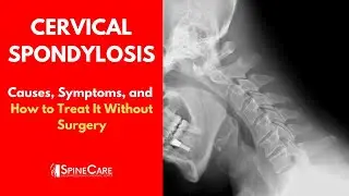 CERVICAL SPONDYLOSIS Causes, Symptoms and Treatment (NO SURGERY)