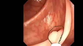 Resection Techniques for Colonic Polyps: Cold Forceps Polypectomy, Hot Biopsy, Cold Snare, Hot Snare