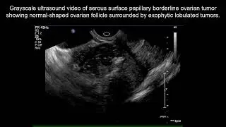 #UOGJournal clip on ultrasonographic features of serous surface papillary borderline ovarian tumour