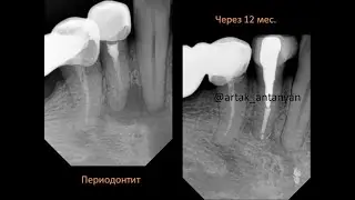 Болит зуб после лечения корня? Киста зуба Периодонтит Зуб имплант Виниры Удаление кисты зуба Пульпит