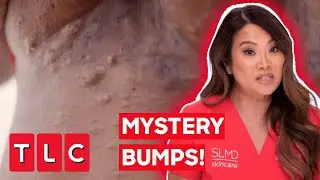 Dr. Lee Pops DOZENS Of Mysterious Bumps! | Dr Pimple Popper: With Every Cyst-mas Card I Write