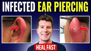 Doctor explains HOW TO RECOGNIZE AND TREAT INFECTED EAR PIERCING