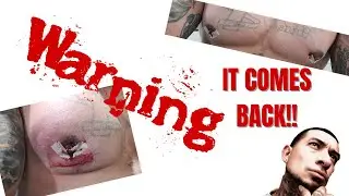 OH NO!! MY GYNO CAME BACK | 1YR SURGERY UPDATE | WARNING !!