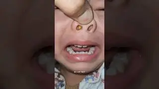 Something Stuck In Nose 😵  | How Doctor Remove It |        #shorts