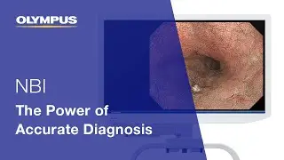 NBI: The Power of Accurate Diagnosis | EVIS X1 | Gastroenterology | OLYMPUS