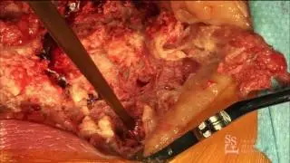 Pelvic Screw Placement - Tyler Koski, MD (lab demo)