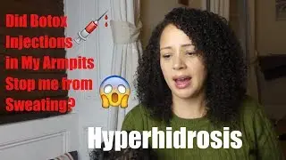 Did 15 Botox Injections in Armpits Stop Excessive Sweating? Hyperhidrosis Treatment| Sweaty Armpits
