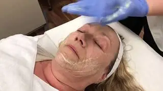 Performing a 3 step Peel in Metro Detroit- Dr. Anthony Youn