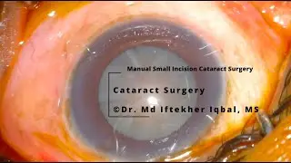 MIIQ 64: Cataract Surgery || Manual Small Incision Cataract Surgery || DR. MD IFTEKHER IQBAL RAJU