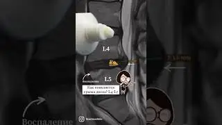 Как появляется грыжа диска L4-L5.