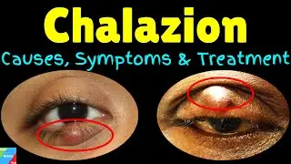 Chalazion: Symptoms, Causes, Diagnosis, Treatments & Prevention | Eyelid Cyst | Meibomian Cyst