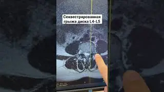 Секвестрированная грыжа L4-L5. 