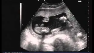 A Pregnancy Ultrasound video from Elite Private clinic