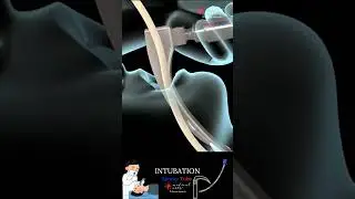 Intubation - EndoTracheal Tube - Breathing Tube #medicalanimation
