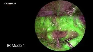 Real-Time Fluorescence (Infrared) Laparoscopy - How it works