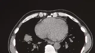 SSM Health Medical Minute – Bronchoscopy Can Better Detect Lung Cancer