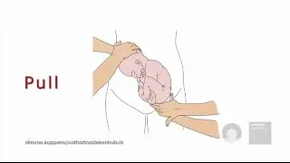 External Cephalic Version (ECV) technique in theory (animation)