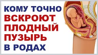 Амниотомия. Вскрытие плодного пузыря. Родить 