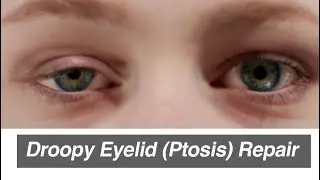 Droopy Eyelid (Ptosis) Repair