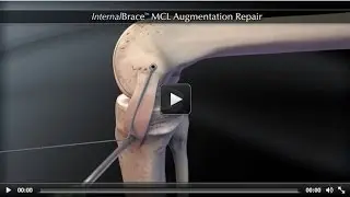 InternalBrace™ MCL Augmentation Repair