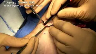 Volar Ganglion Cyst Excision