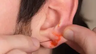 EAR PIERCING GONE WRONG!