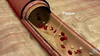 What Is Coronary Artery Disease? | Match Health