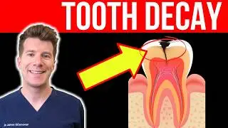 Doctor explains TOOTH DECAY (TOOTH CAVITY) - Causes, Symptoms and Treatment