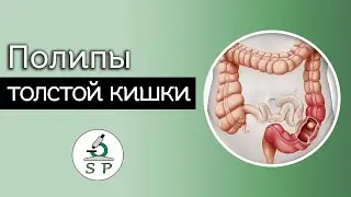 Полипы толстой кишки | Частная патология