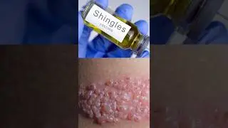 Shingles Vaccine for Chicken Pox | Chicken Pox ko kaise theek karen | Skin Specialist in Delhi