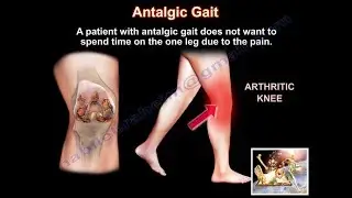 Painful Gait, Antalgic Gait - Everything You Need To Know - Dr. Nabil Ebraheim