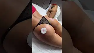 Увеличение ягодиц филлером , обучение 