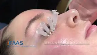 IFAAS Exclusive: PDO Inch Thread for Under Eye Rejuvenation