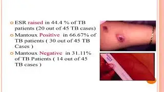 AIOC2018 - Fp23 - Uvea - Topic - Real Time PCR in Infectious Uvei....