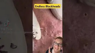 ENDLESS BLACKHEAD REMOVAL - So Many Blackhead Pops #shorts