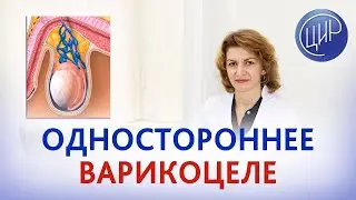 Варикоцеле с одной стороны приводит к бесплодию? Отвечает Дементьева С.Н., врач акушер-гинеколог ЦИР