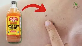 How To Use Apple Cider Vinegar To Remove Warts